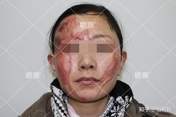 治疗案例:面部硫酸烧伤瘢痕增生