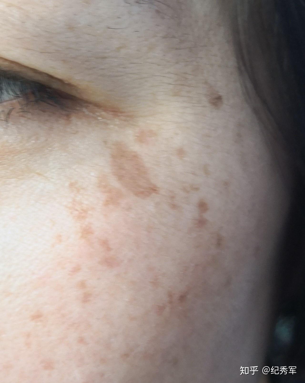 非剥脱点阵激光留下网格印 色沉? - 知乎