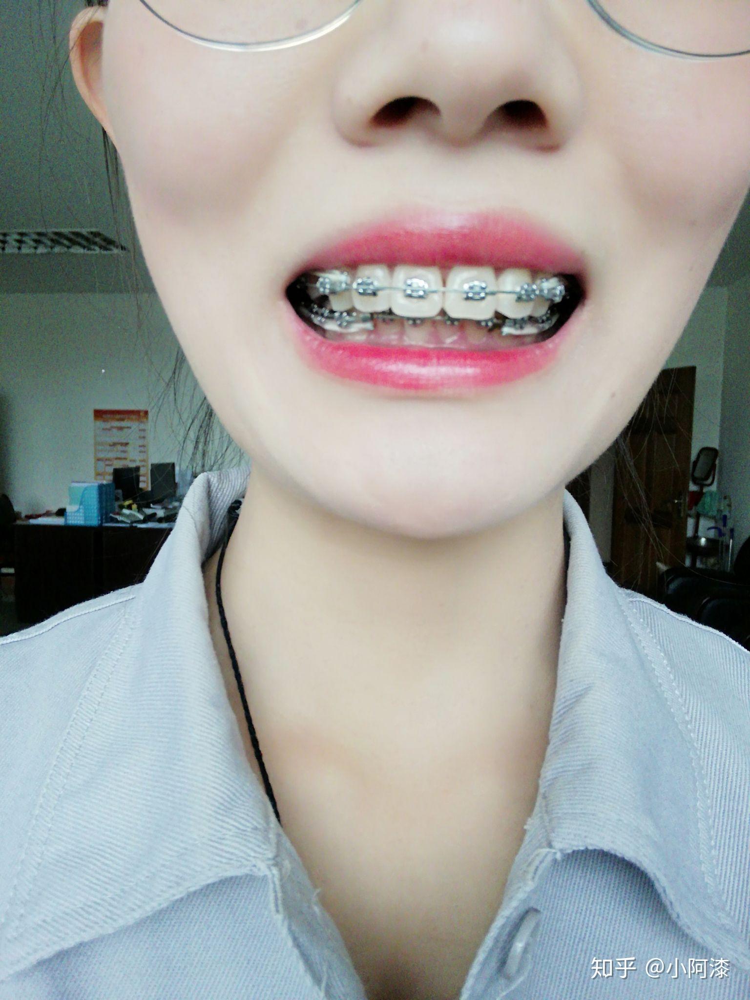 全同步带状弓矫治技术的优缺点有哪些? - 知乎