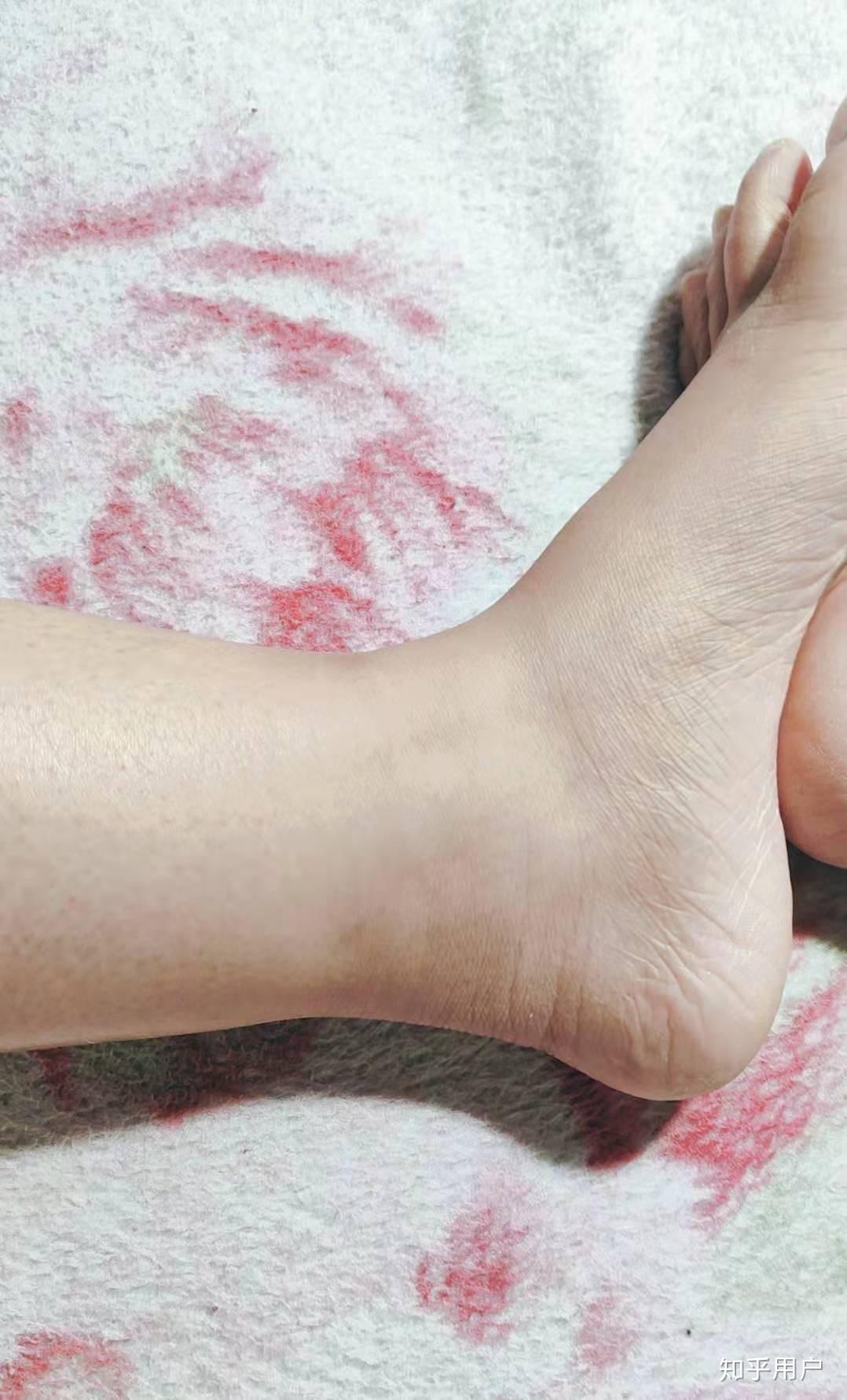 女生脚踝粗是基因决定的吗