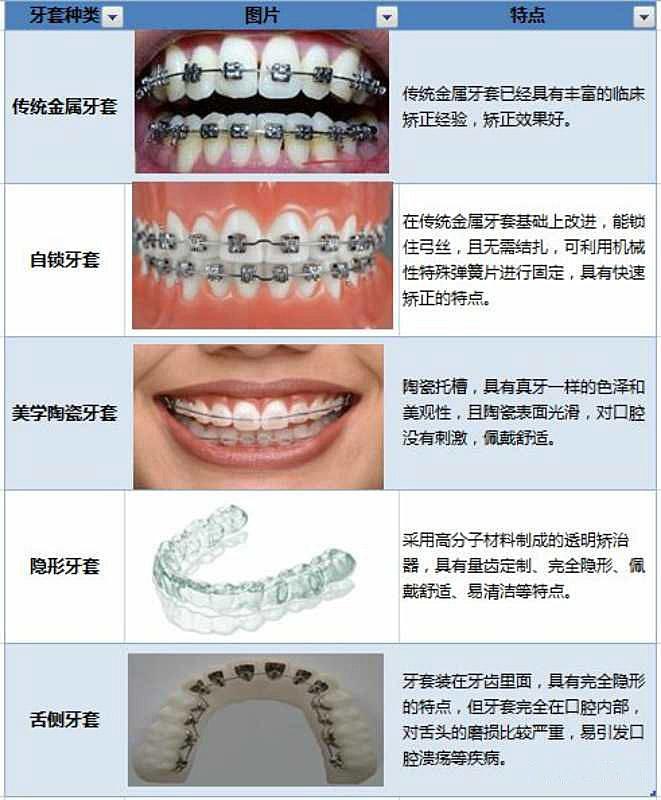 牙套种类 对比区别 知乎