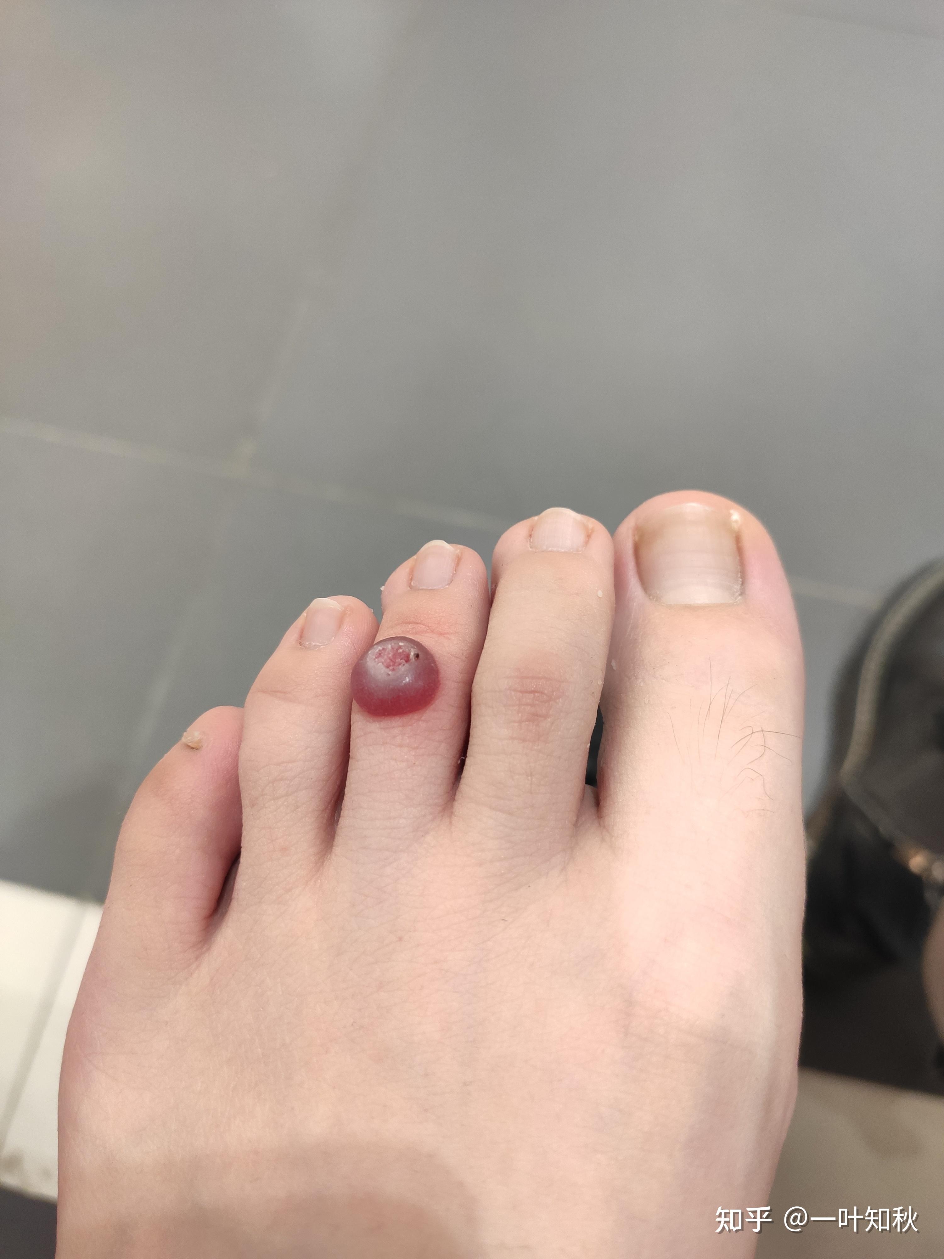 液氮冷冻治疗后手指上出了血泡而且越来越大该怎么办