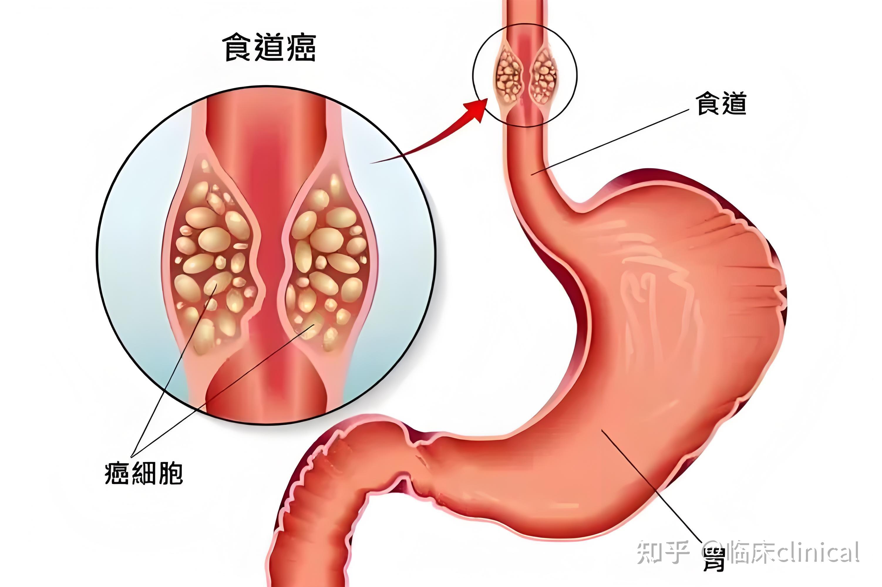 食道癌的位置图片大全图片