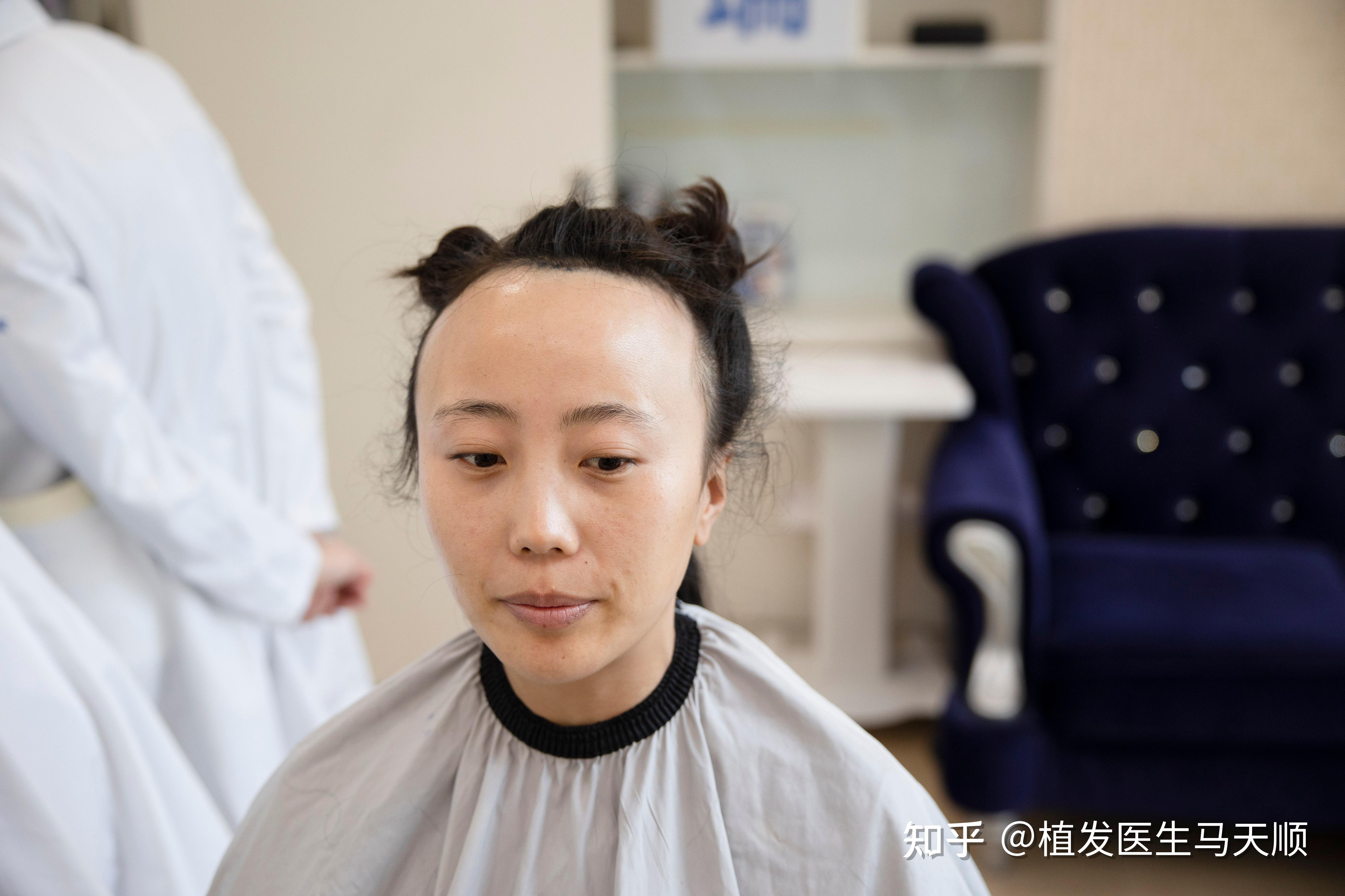 挑战全网蕞大女性植发数量，种植4800单位的大脑门是什么样？！ - 知乎