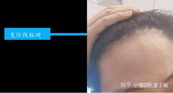 怎样的发际线才叫好看?发际线对容貌的影响有多大?