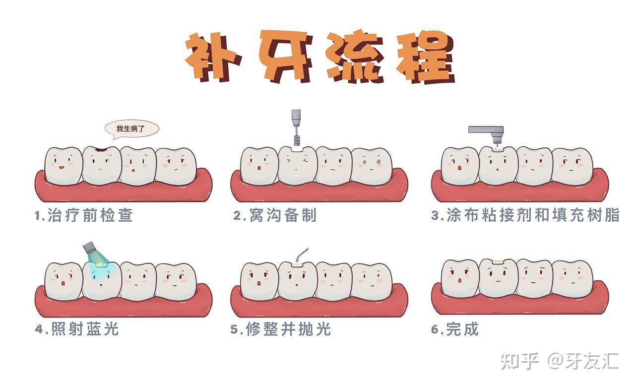补牙后的牙齿到底能用多久? - 知乎