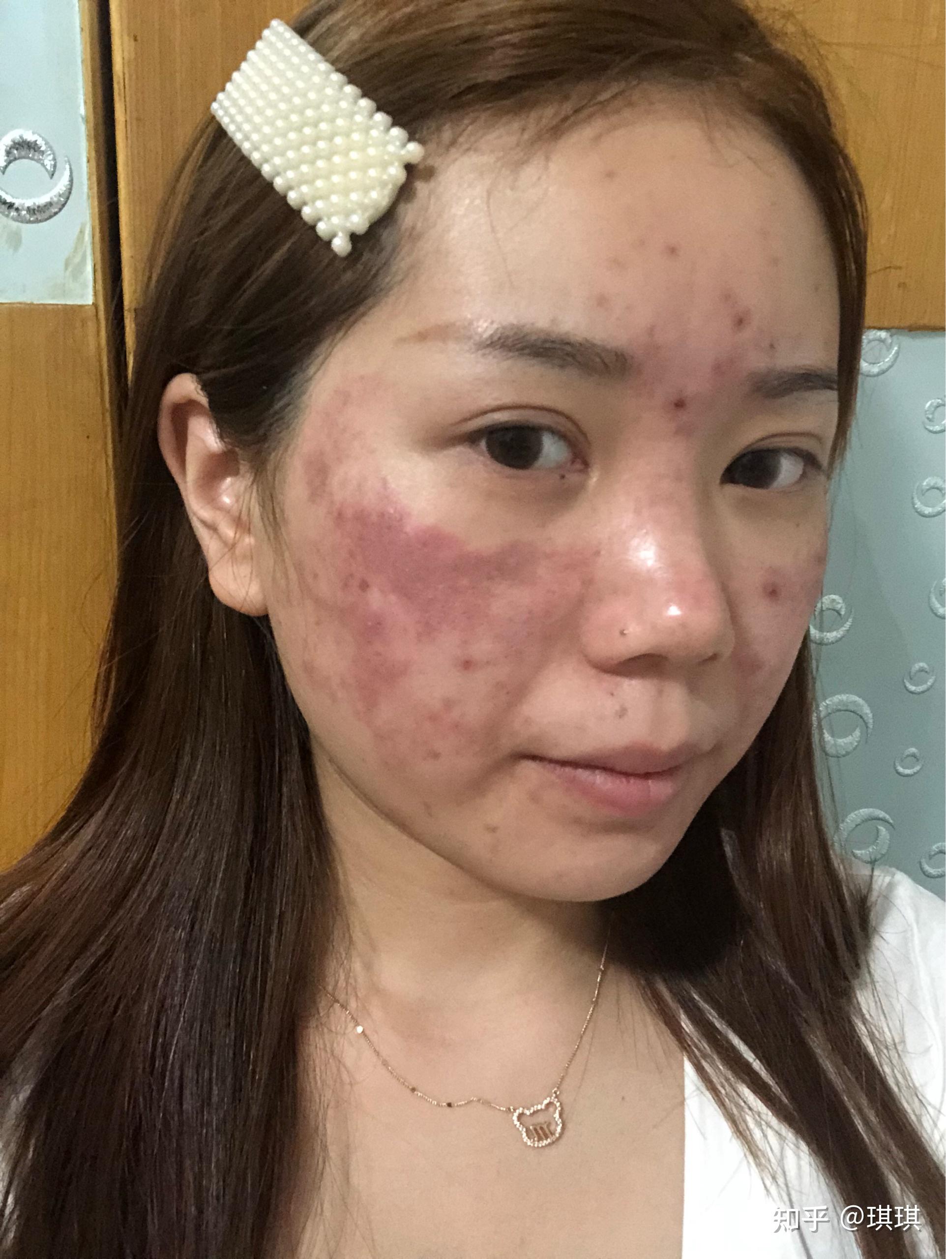 去医院做完水杨酸焕肤脸上烧伤第二天掉皮露出肉怎么办? - 知乎