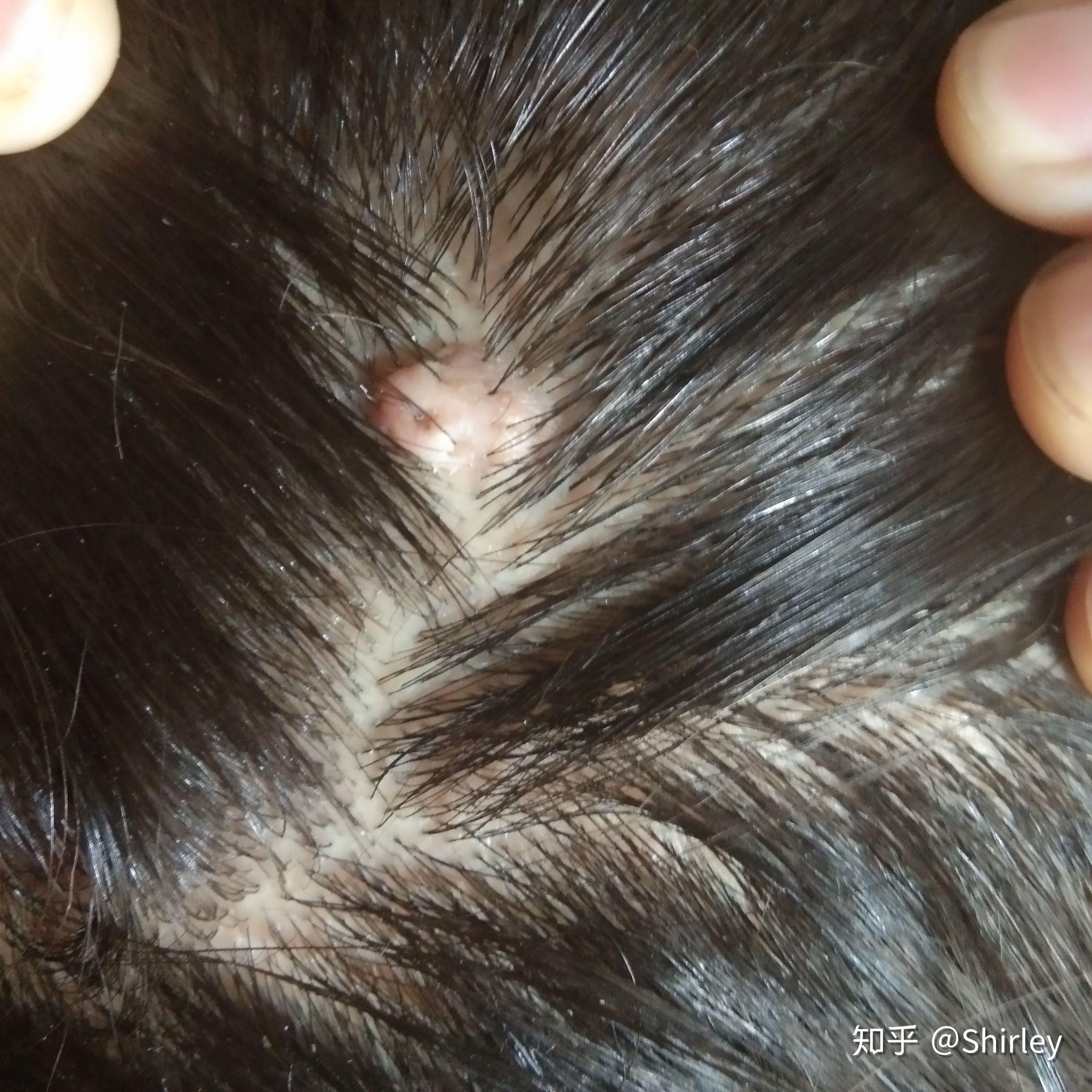 后脑勺长了一个肉疙瘩