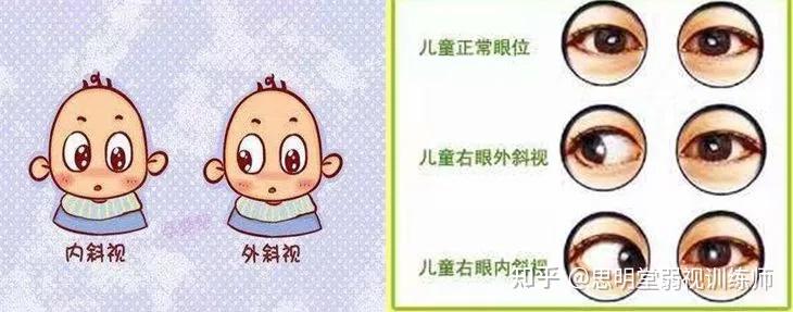 什么叫弱视？什么叫斜视性弱视？看完你就懂了！ - 知乎