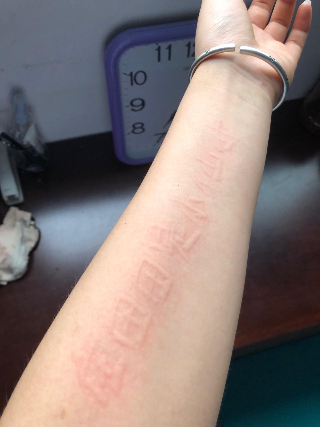 人工荨麻疹(皮肤划痕症)的原理是什么?有治疗的必要么?