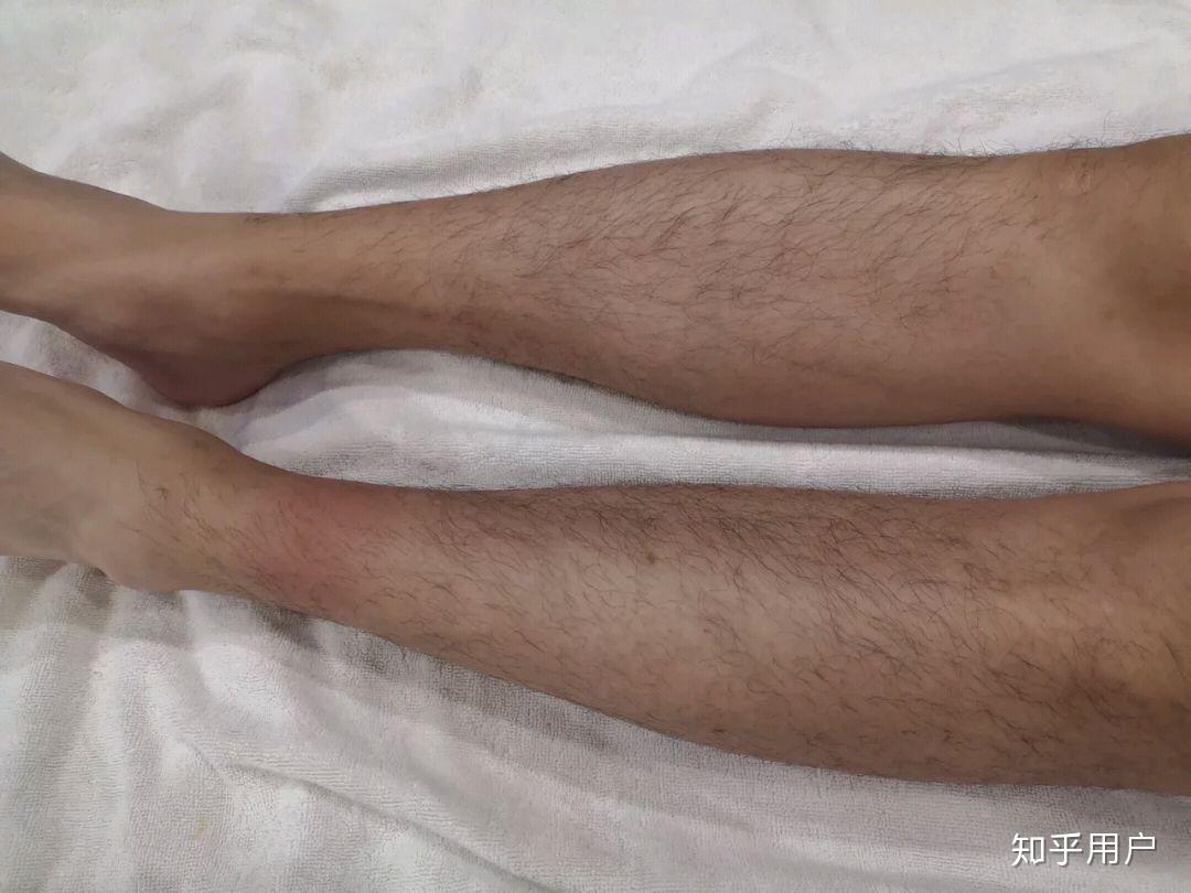 作为一个男生适合脱毛吗哪里的毛可以脱脱毛要注意什么