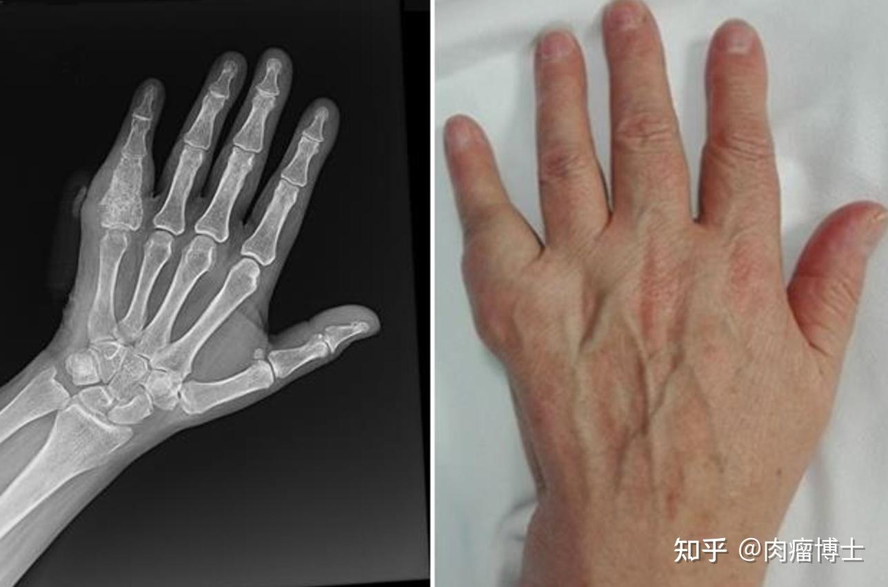 颞下颌滑膜软骨瘤图片