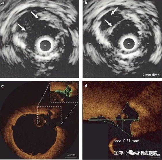 Nature Reviews：冠脉微血栓新看法 - 知乎