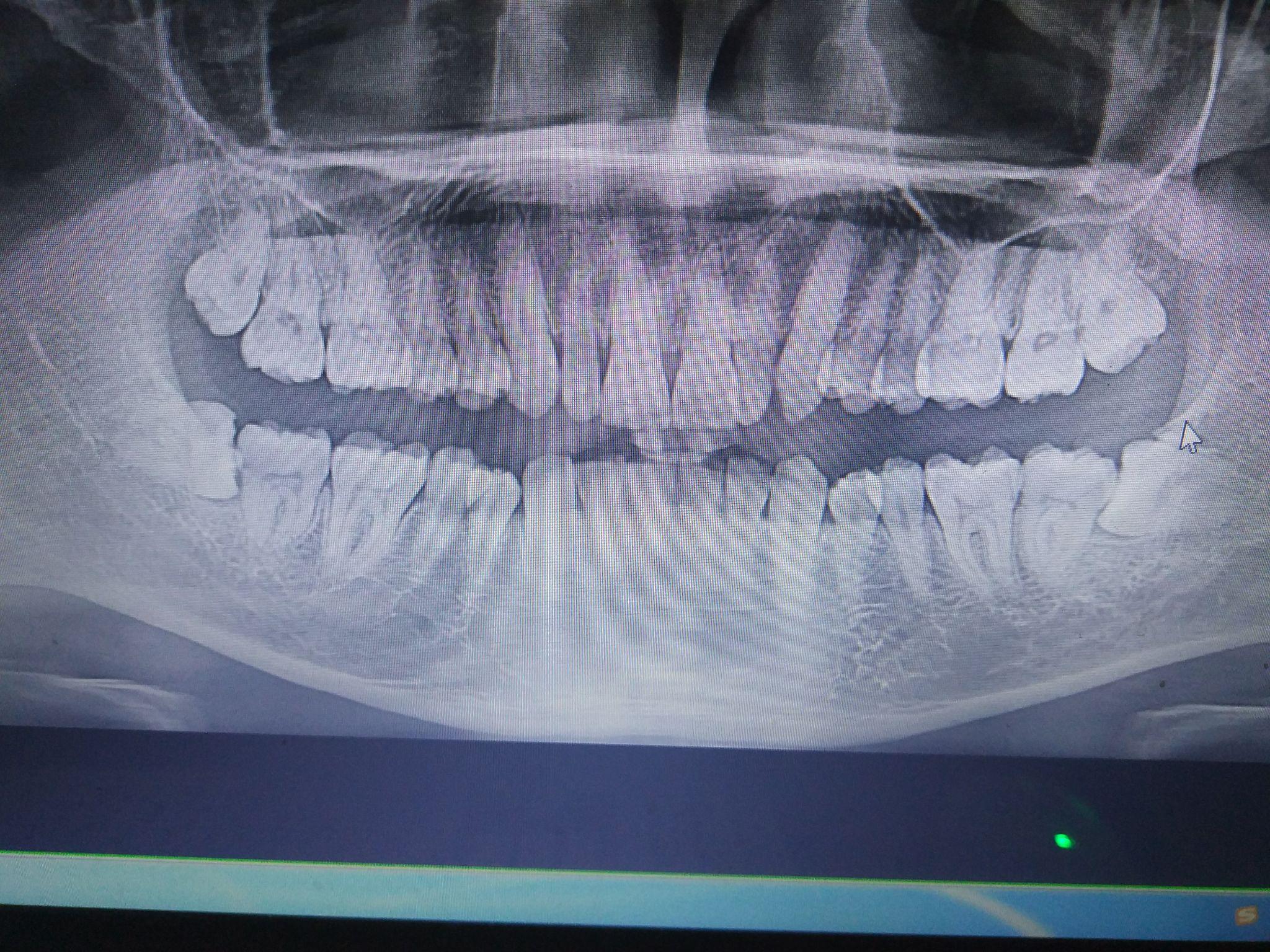 智齿牙齿拍片图片