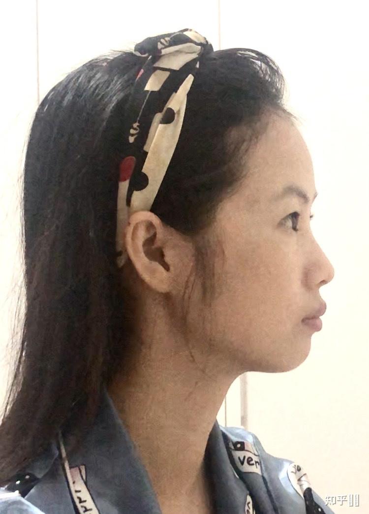 牙齿挺整齐的但是嘴凸特别是上唇正畸有用吗