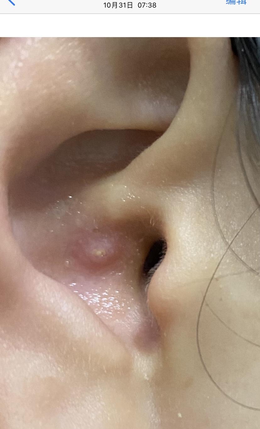 怎样对付外耳道的疖肿? - 知乎