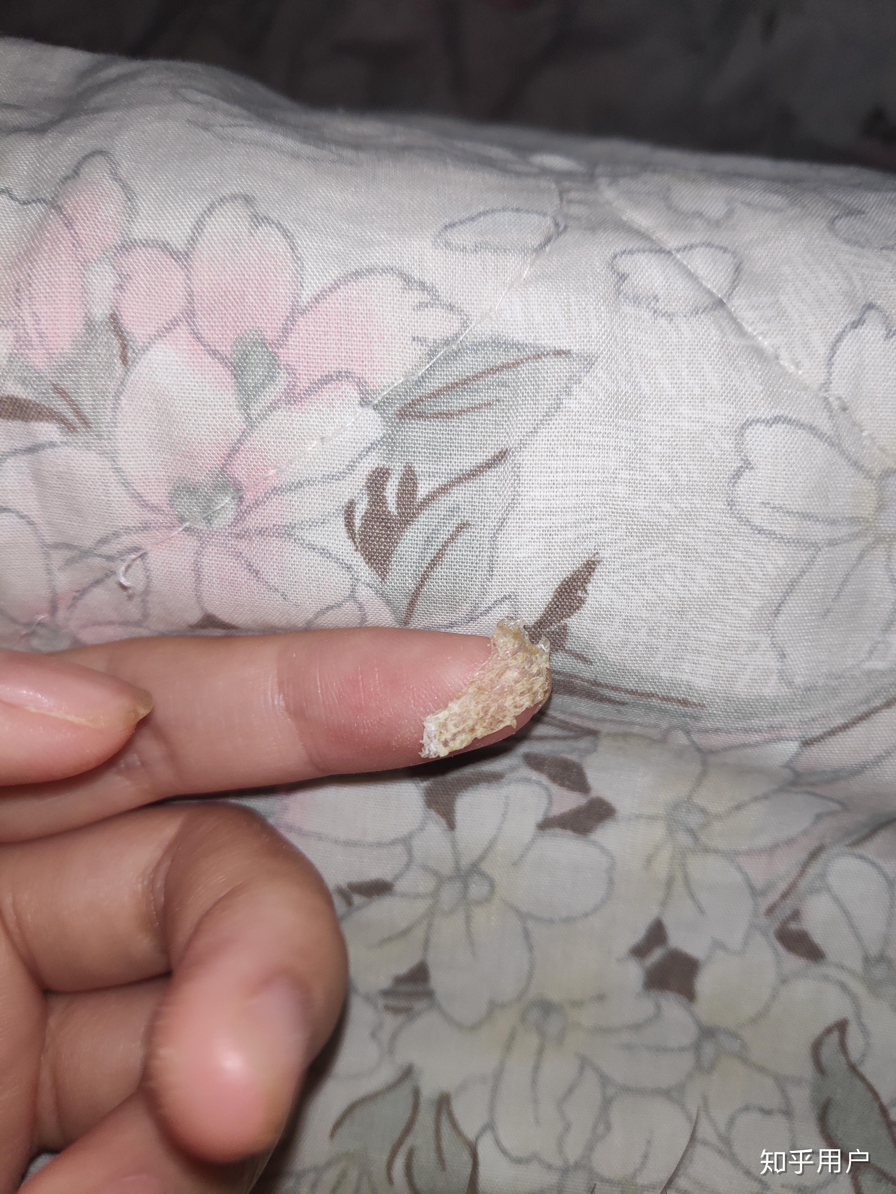 见过的最大头皮屑多大