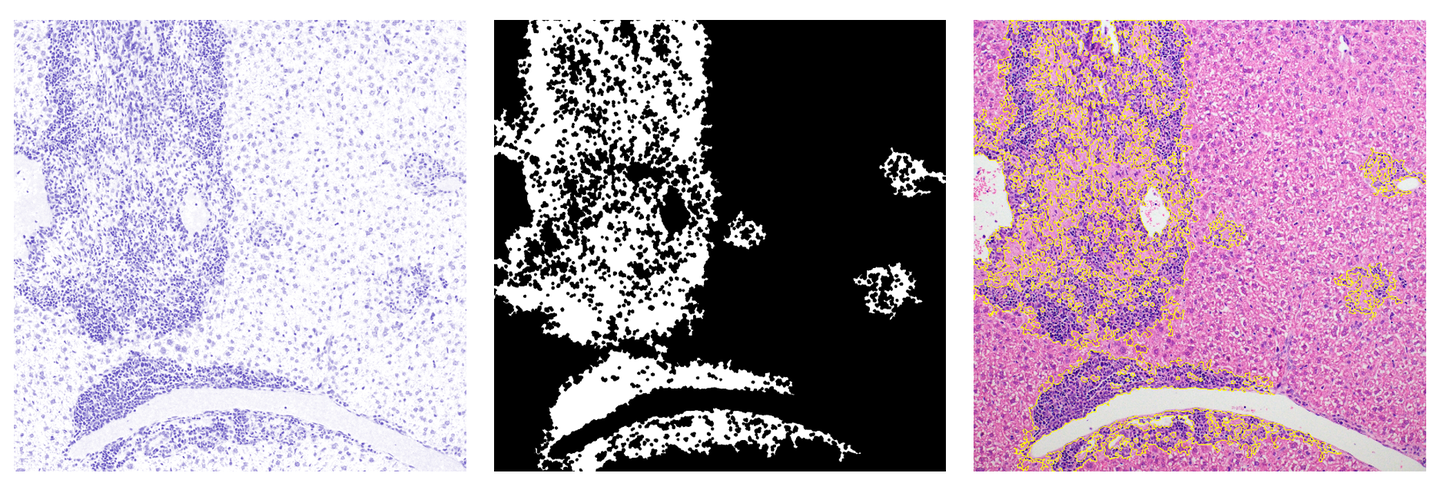 ImageJ实用教程——HE染色炎症浸润面积统计(案例分析篇) - 知乎