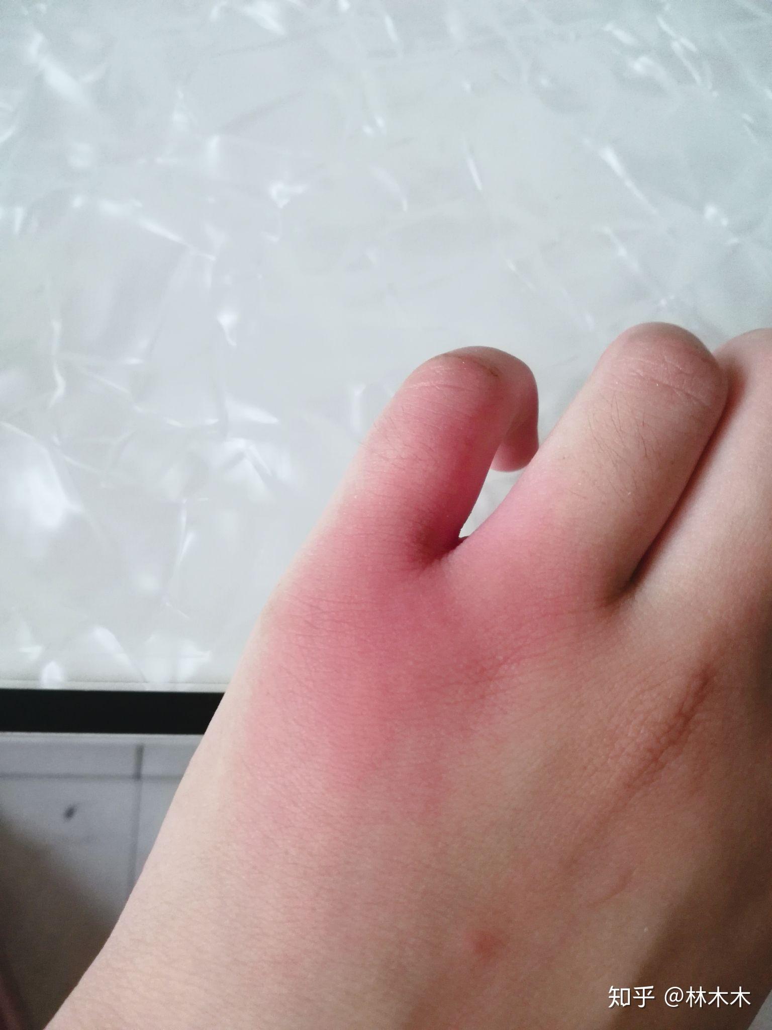 洋辣子有毒吗?被蜇后怎么处理?