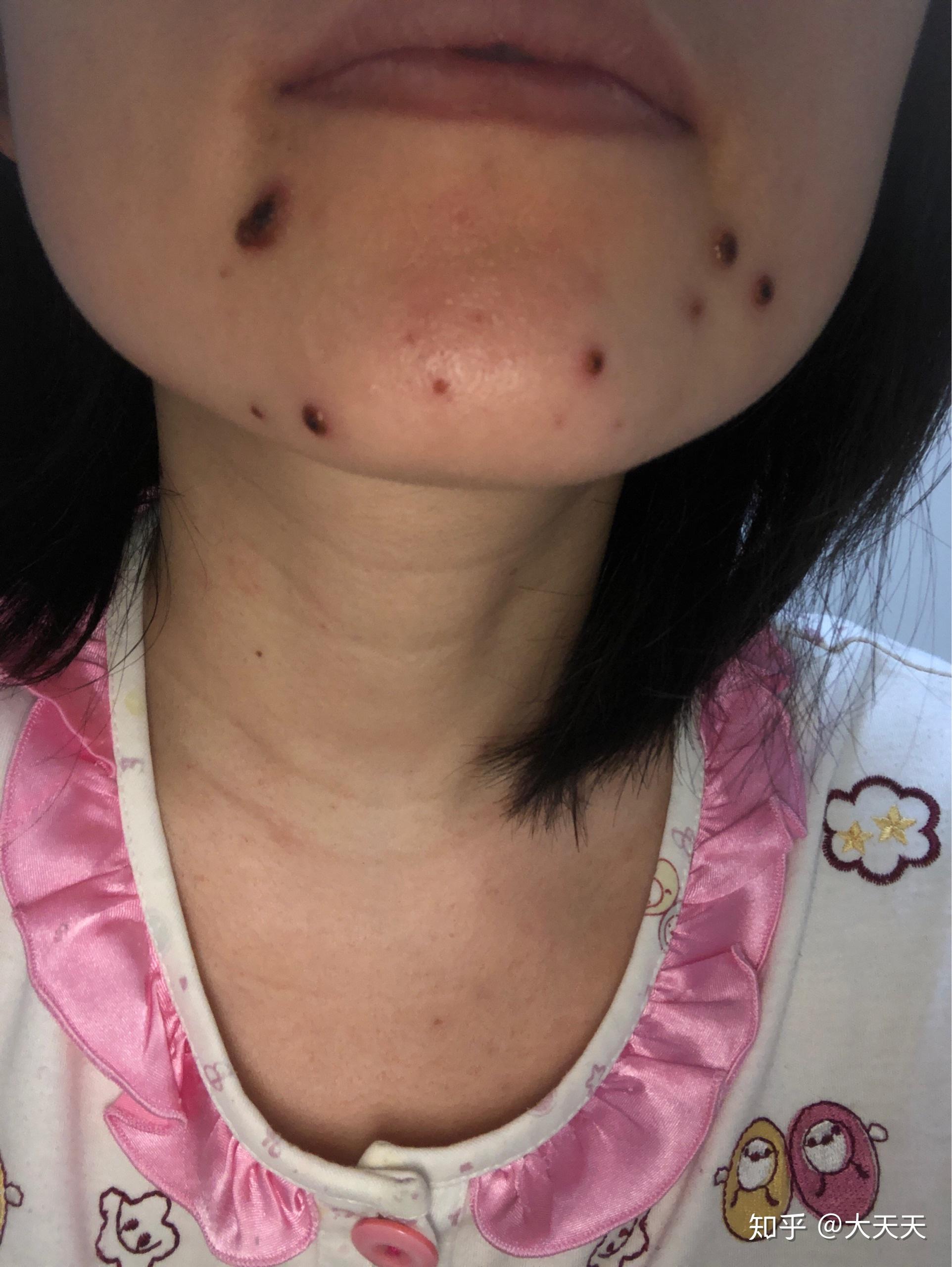 成人长水痘是什么样的经历