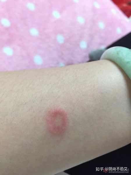 请问这是梅毒潜伏期的症状吗?