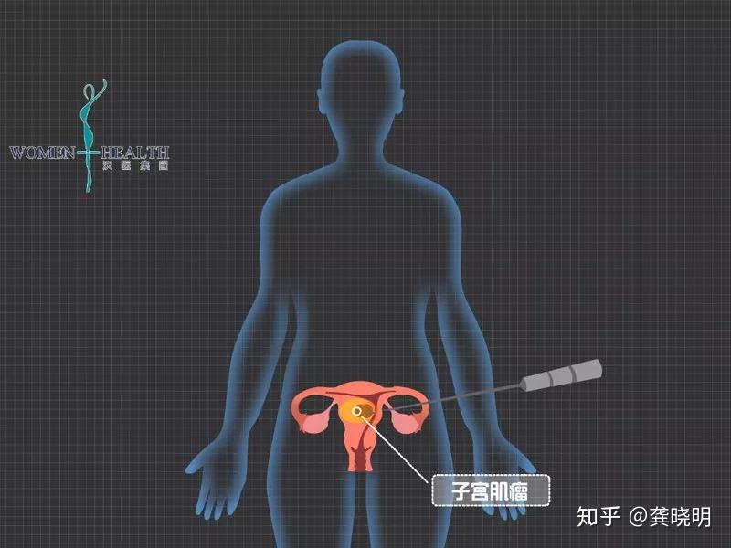 女性子宮腺肌症是一種什麼體驗