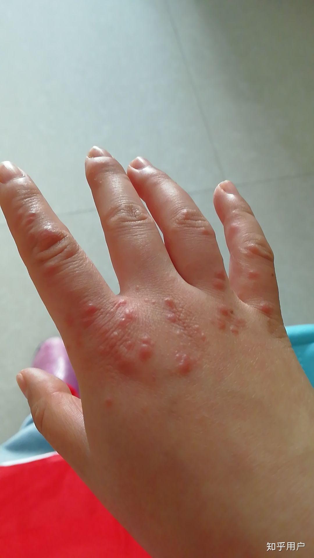 一双10多年的冻疮手好难看