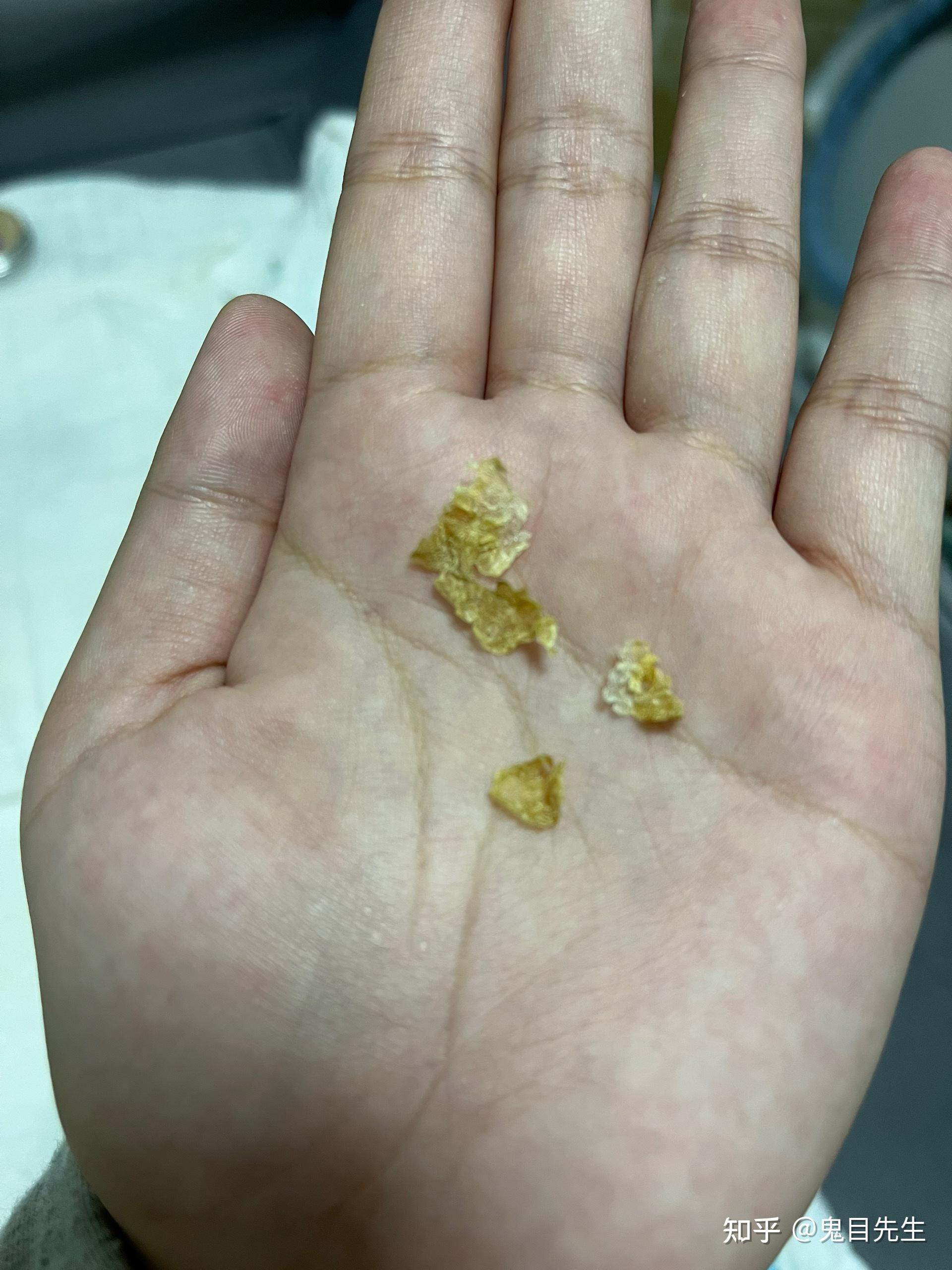 掏出一块超大耳屎,是种什么体验? - 知乎