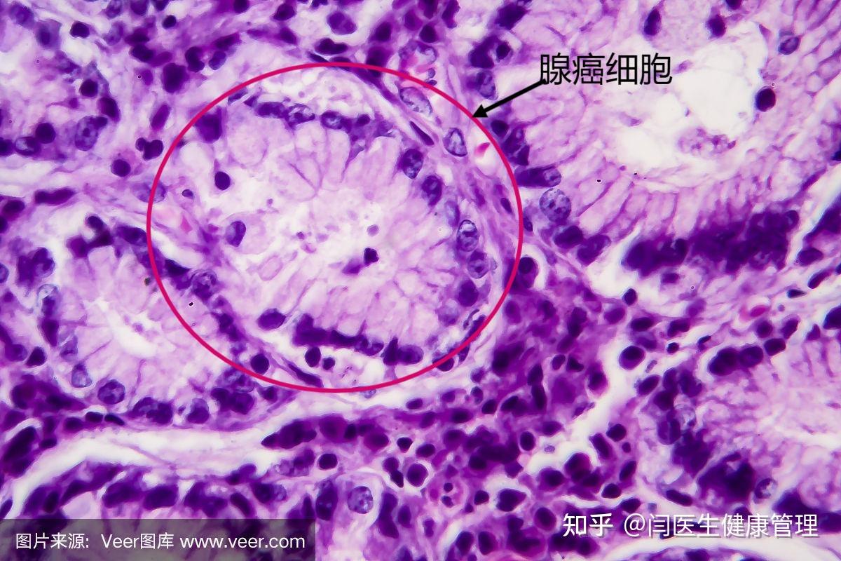 一例胃癌患者的病例分享(二) - 知乎