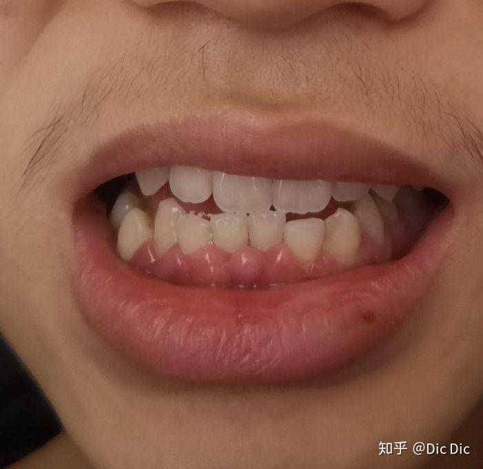 我这个是牙龈增生吗