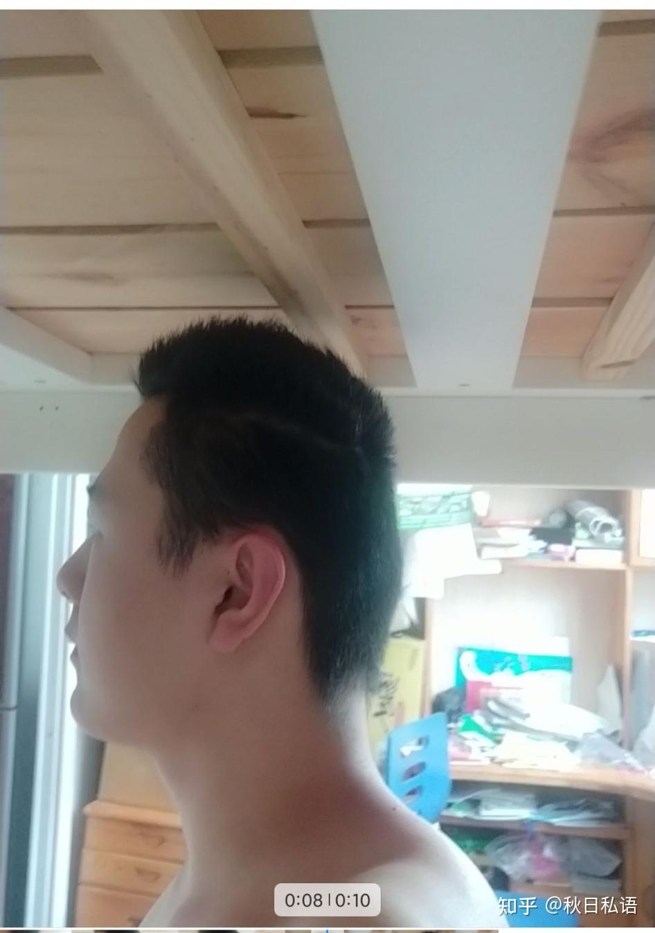 重度扁头对我影响太大怎么缓解自己的自卑