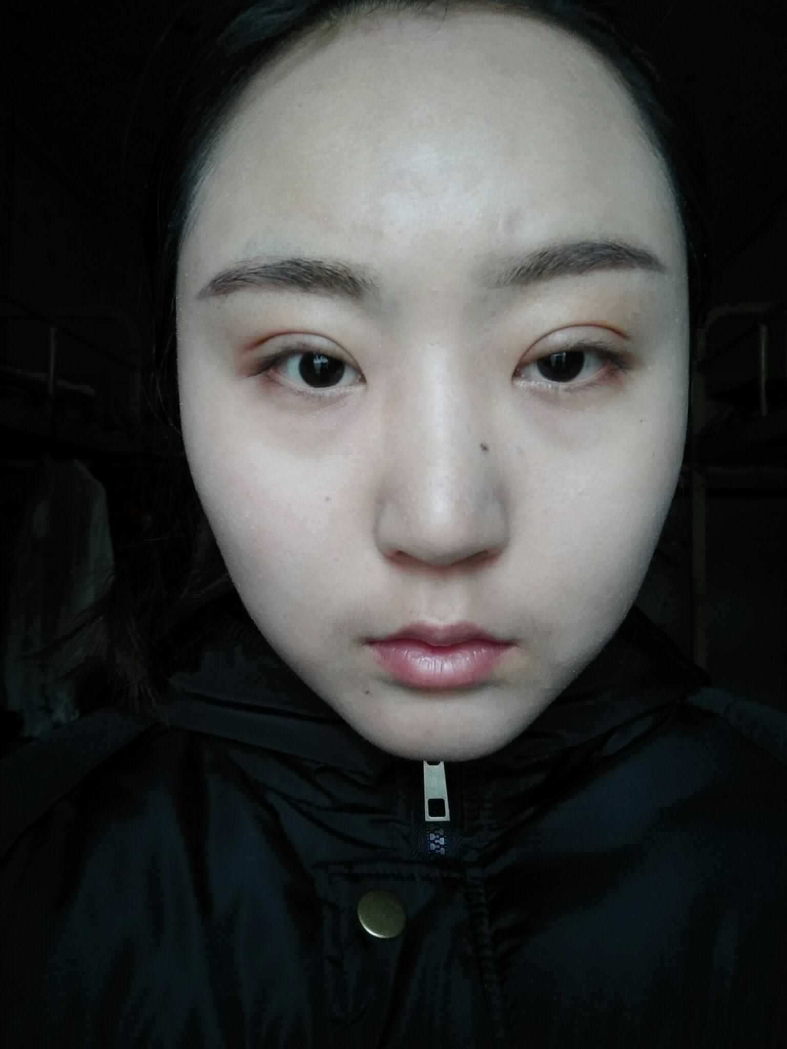 全切双眼皮宽窄不一样呀