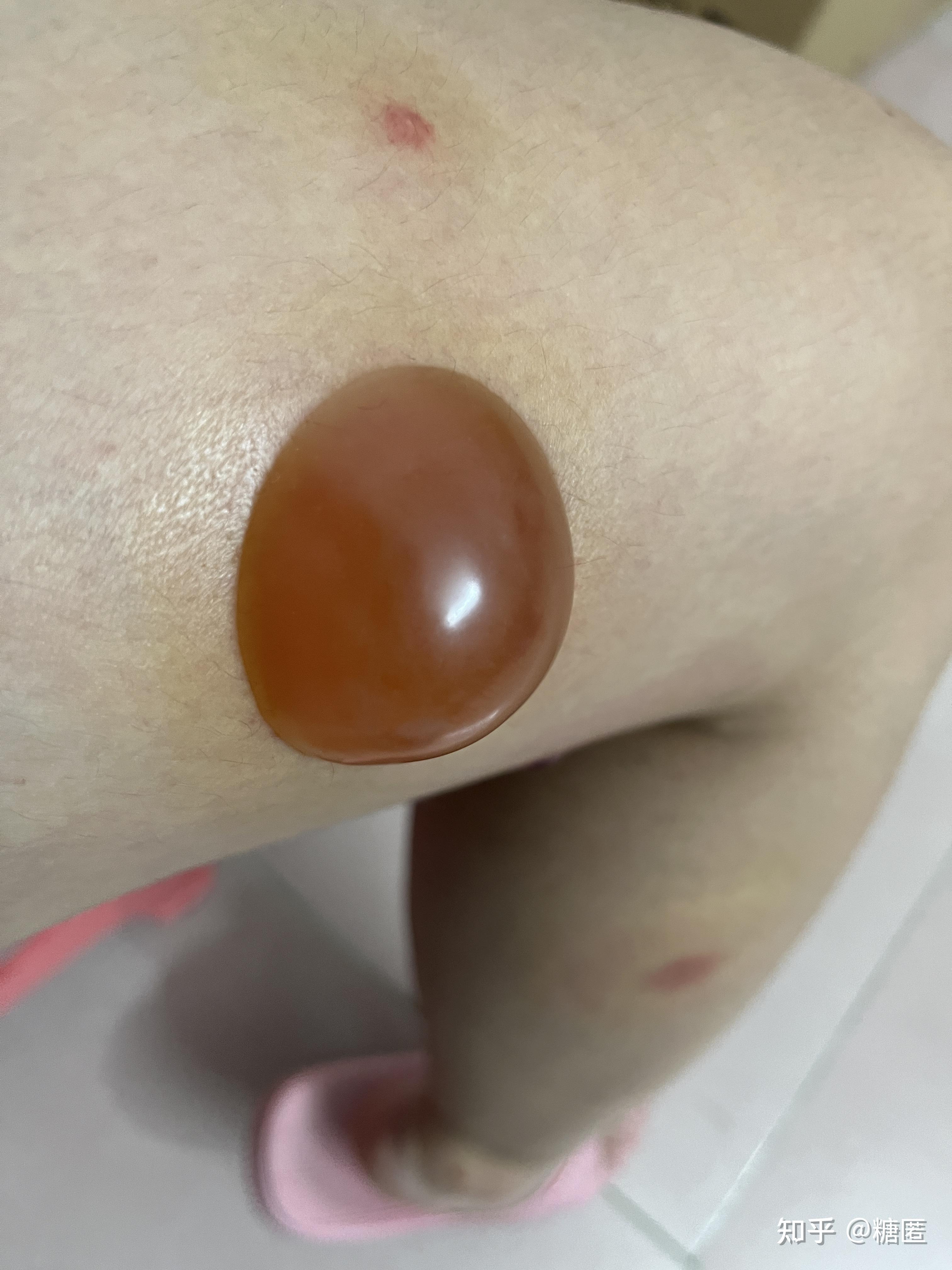 被毒蚊子咬了肿了很大一个包还很硬之后肿的包上面起了水泡挑破之后第