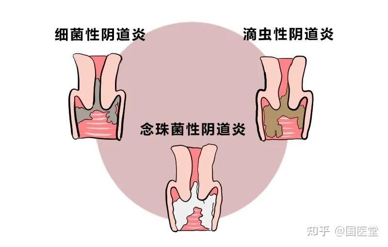 得了细菌性阴道炎怎么办? - 知乎