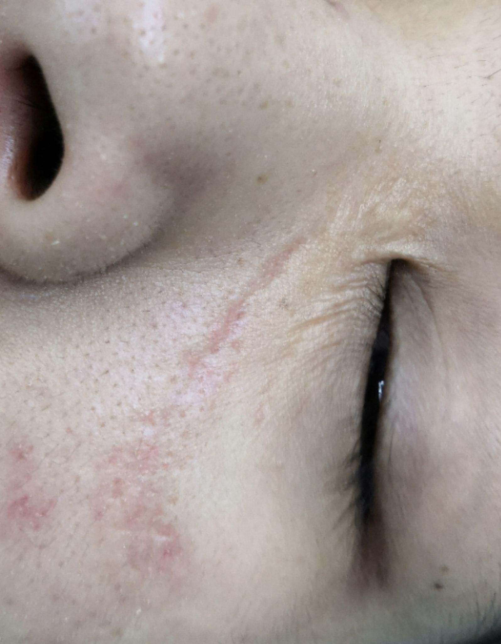 凹陷疤痕怎么修复? - 知乎