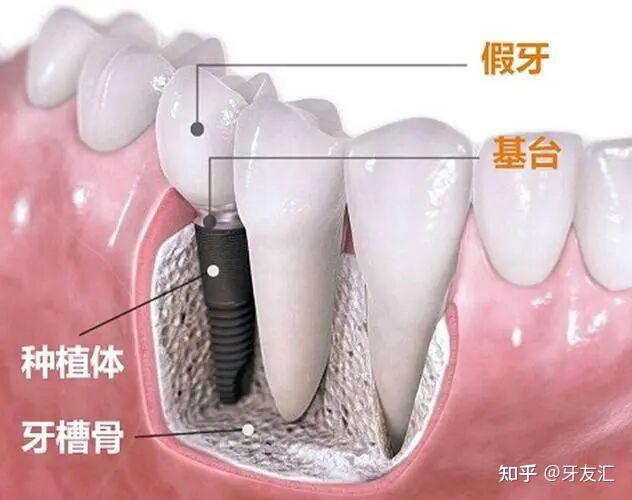 种植牙是怎么种出来的看完这篇懂了