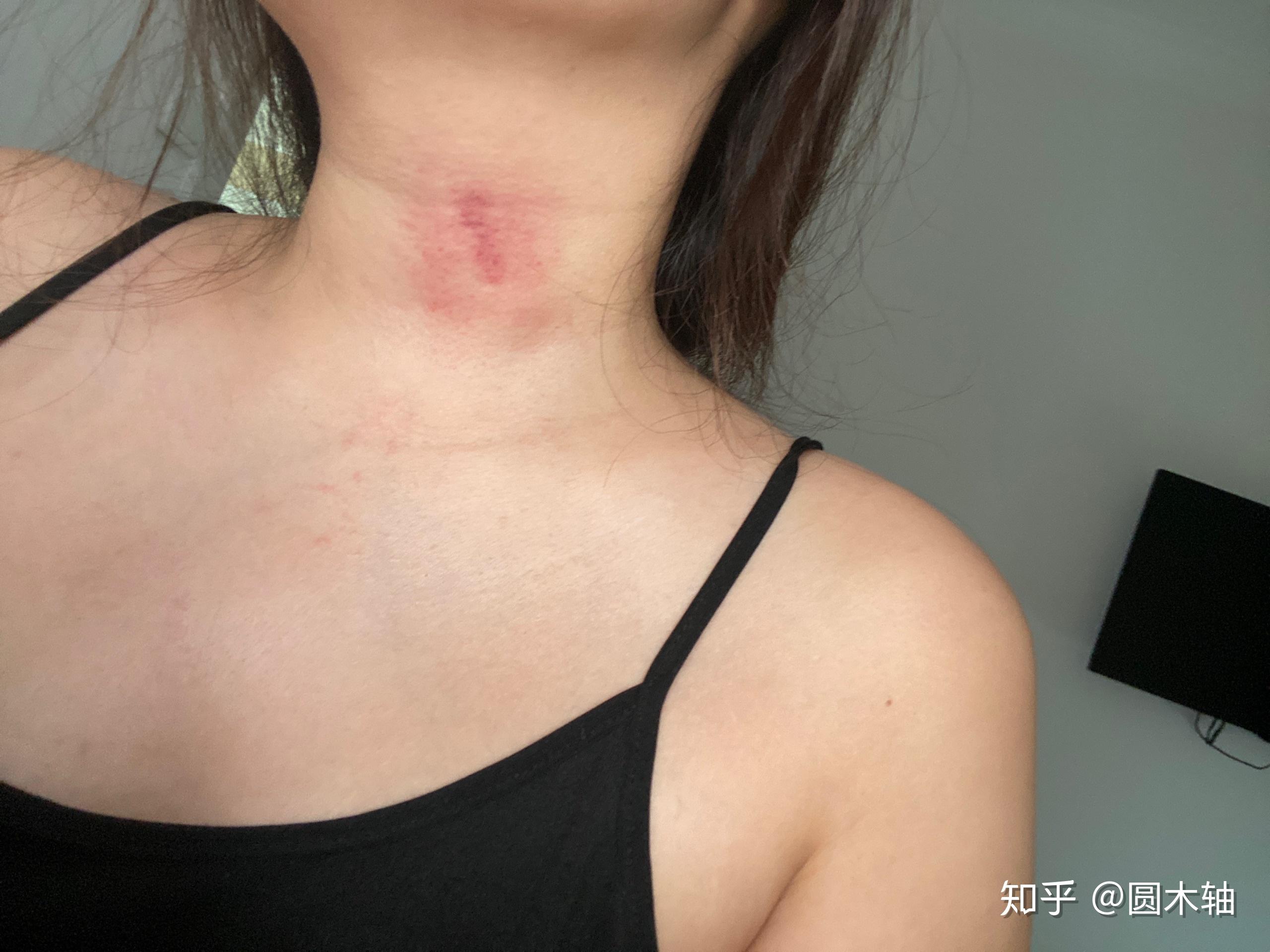 怎么在三小时内消除吻痕? - 知乎