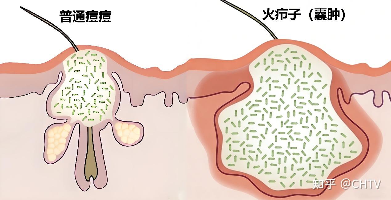 火疖子必须要开刀引流吗? - 知乎