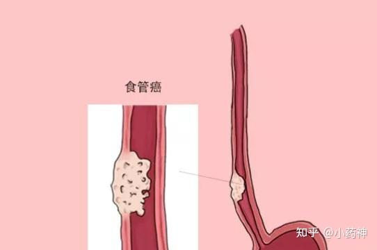 如何预防食管肿瘤?