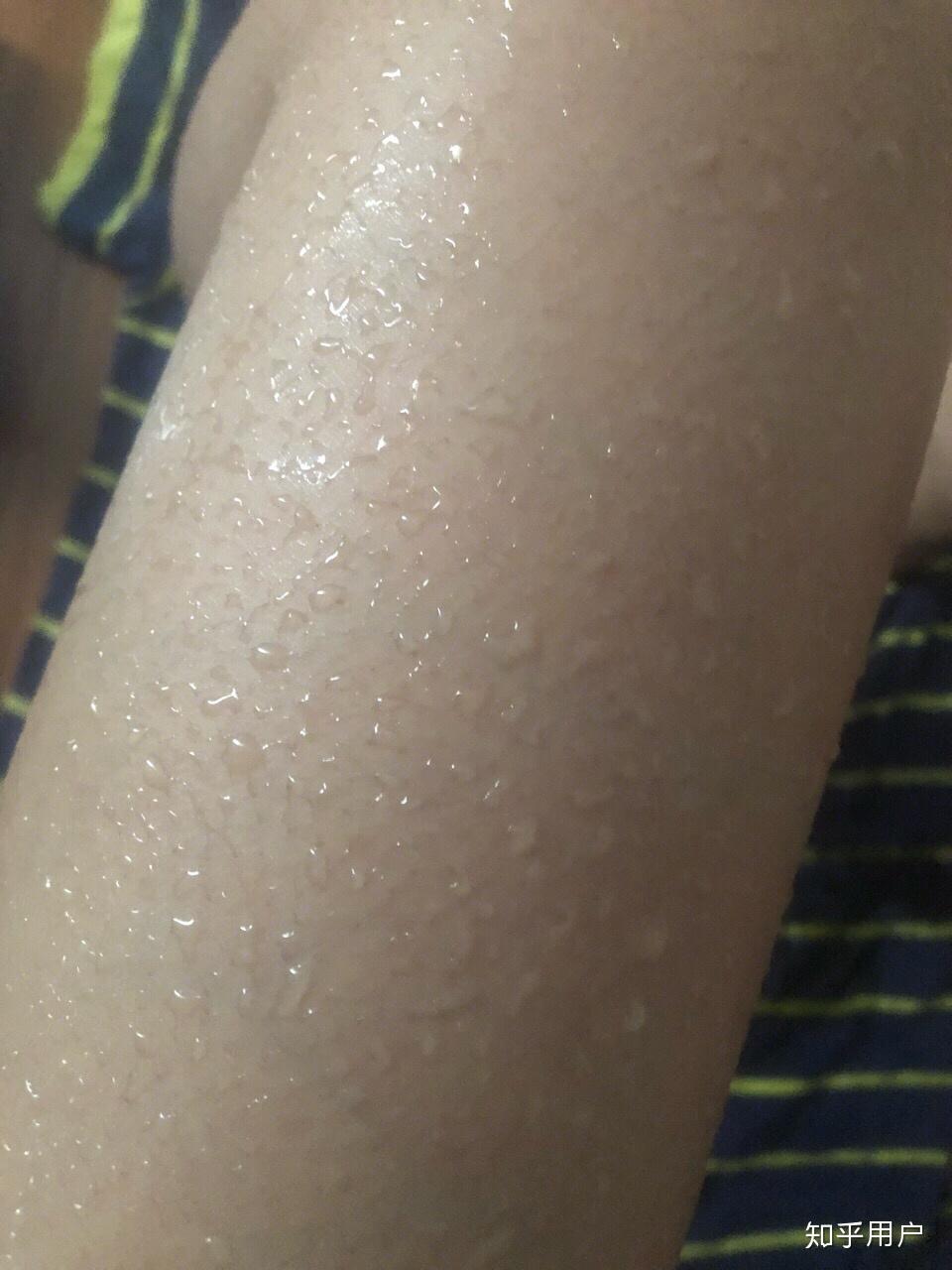 关于鸡皮肤怎么去除最有效知乎的信息