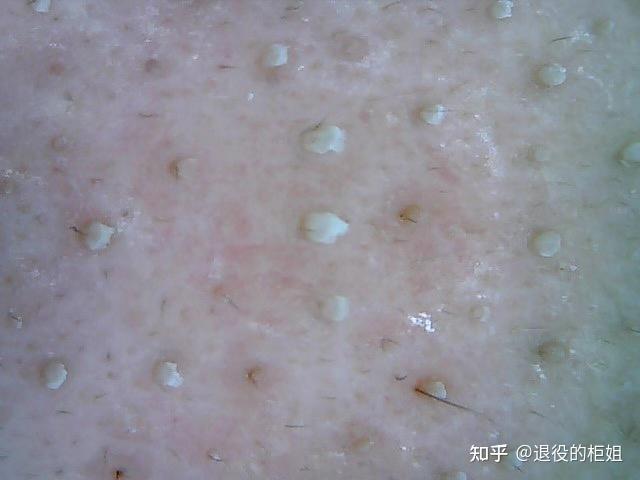 白头粉刺能治愈么? - 知乎