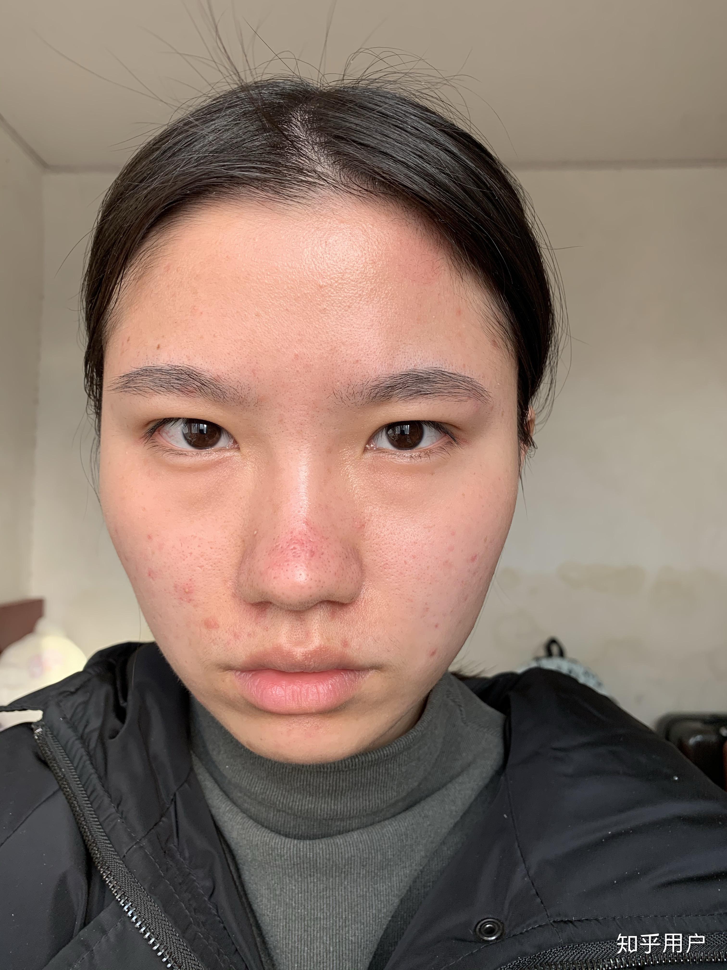 女孩子有酒糟鼻是什么样的体验?