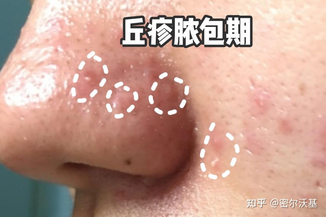 脂溢性皮炎 酒糟鼻 俩一起找我?我才25岁啊.能救我一下么?