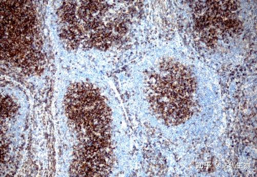 CD3、CD20…揭秘淋巴瘤免疫组化报告上的“CD家族” - 知乎