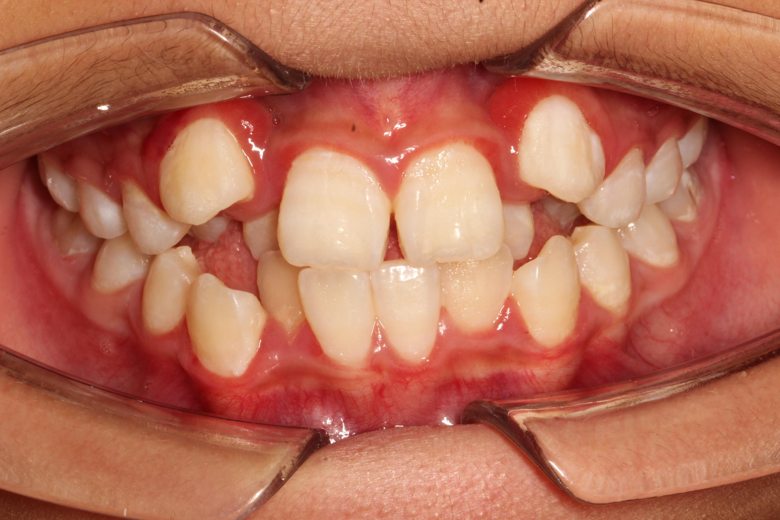 正畸案例：深覆合、露龈笑、牙齿不齐病例分享 - 知乎