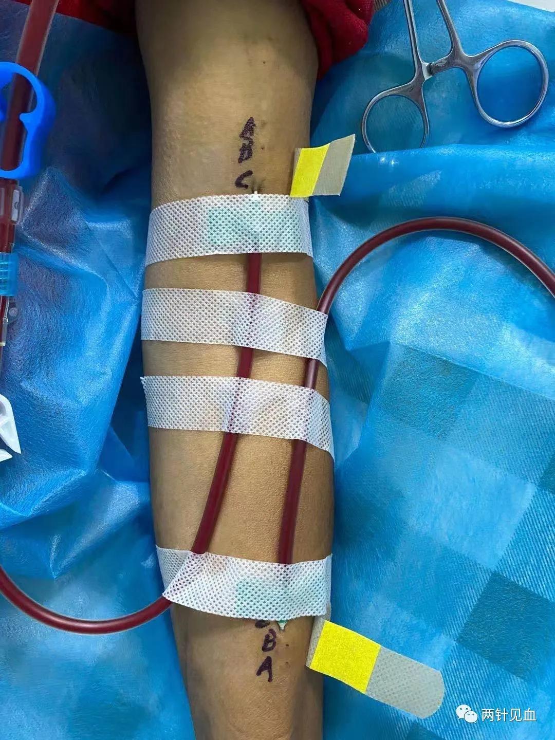 透析病人的瘘怎么护理