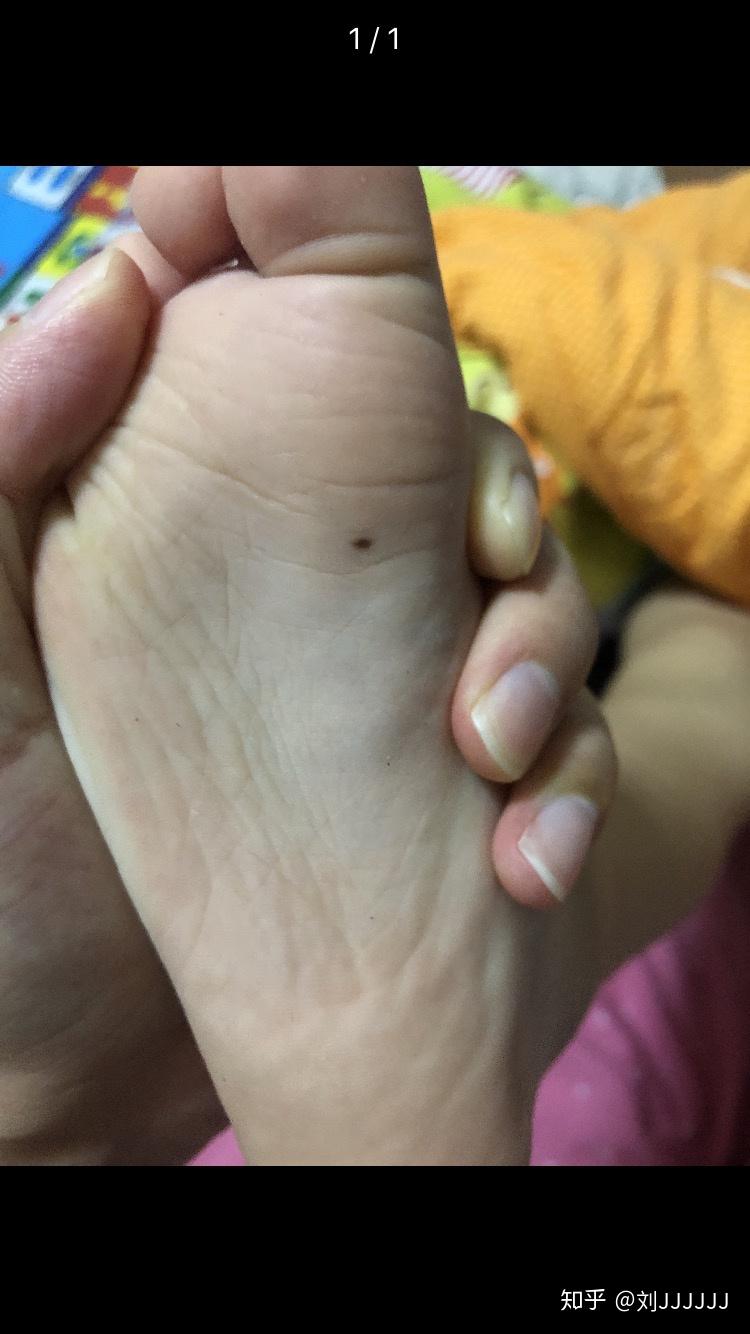 小孩脚底板痣要切除嘛