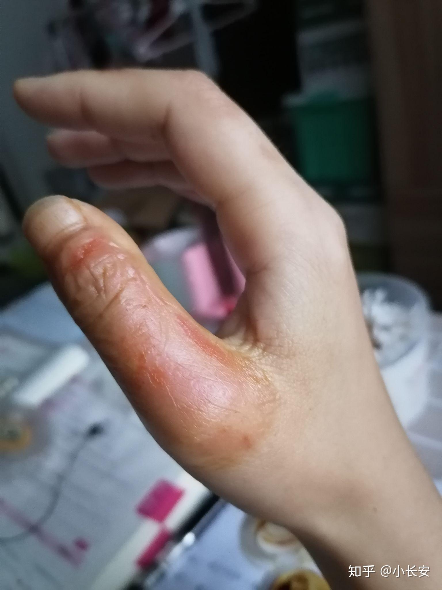手背开水烫伤怎么恢复? - 知乎