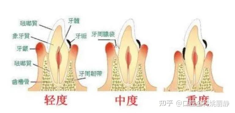 牙周炎可不可以自愈 - 知乎
