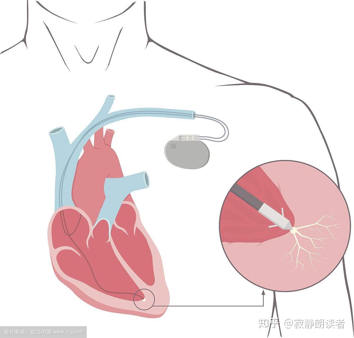 心臟起搏器是什麼原理